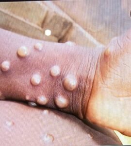 No treatment for Monkey Pox; prevention, early detection is key – DG, GHS